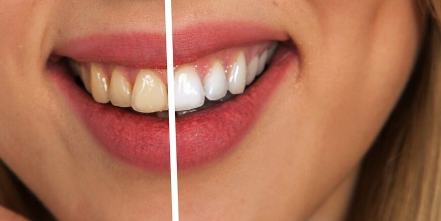 Teeth-whitening- treatment-in-Fremantle